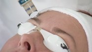 Zabieg laserowego liftingu twarzy