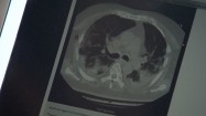 Tomografia komputerowa klatki piersiowej